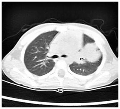 Pulmonary Inflammatory Myofibroblastic Tumor in Children: A Case Report and Brief Review of Literature